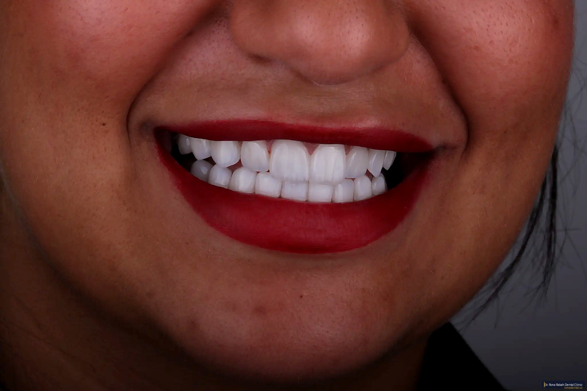 Hollywood Smile · Veneers