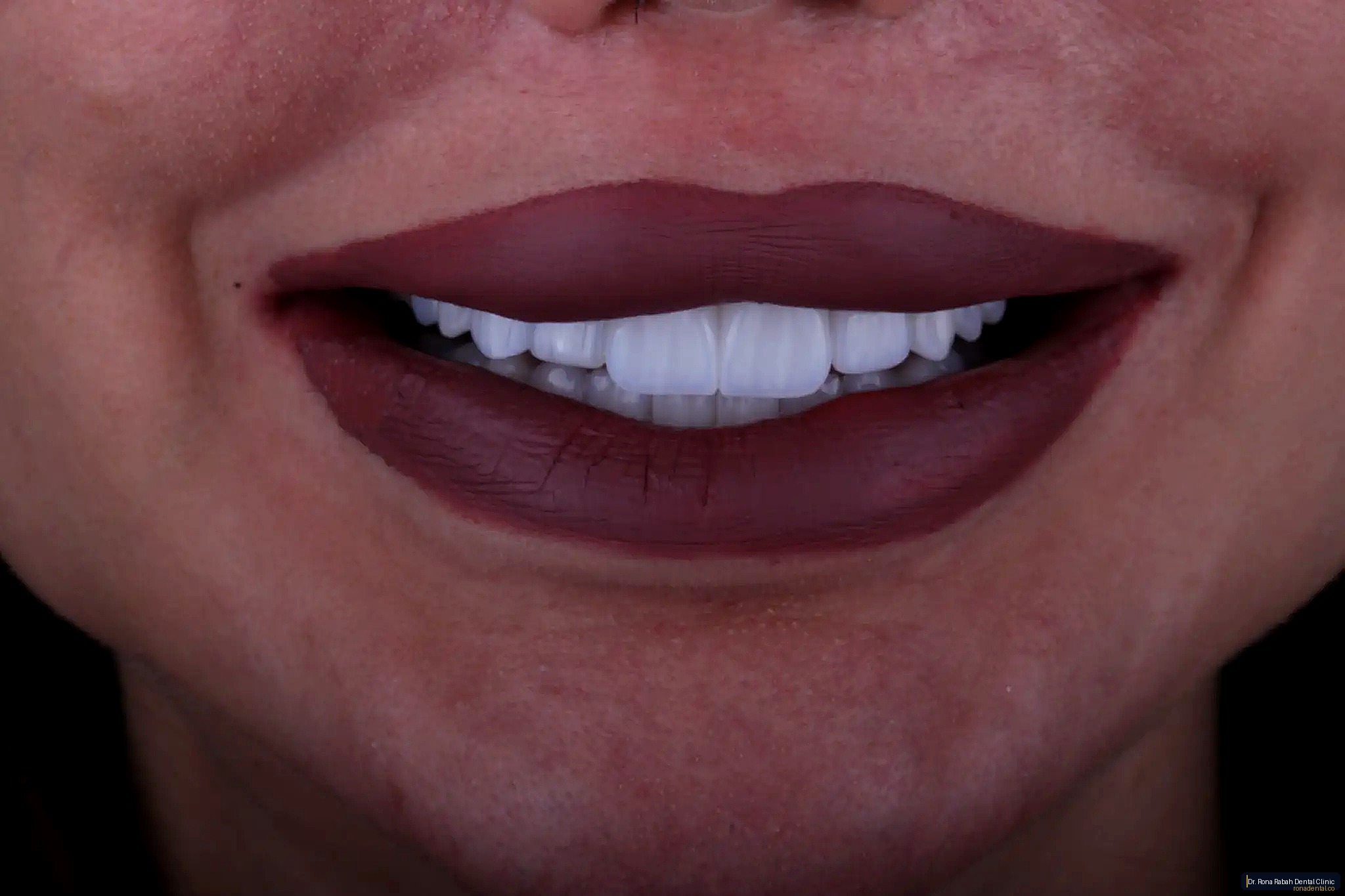 Porcelain Veneers · Smile Design