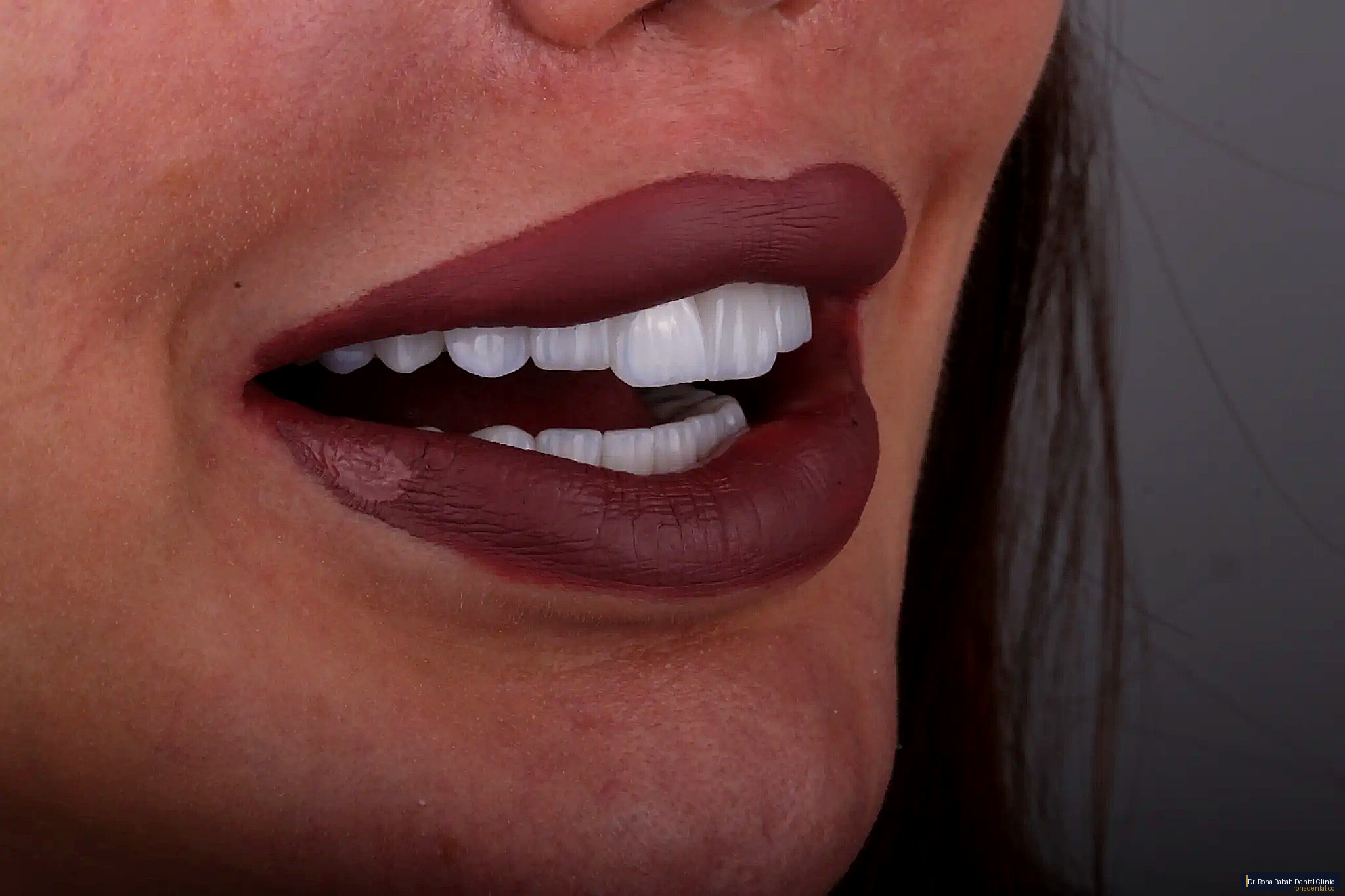 Felspathic Veneers · Natural Look