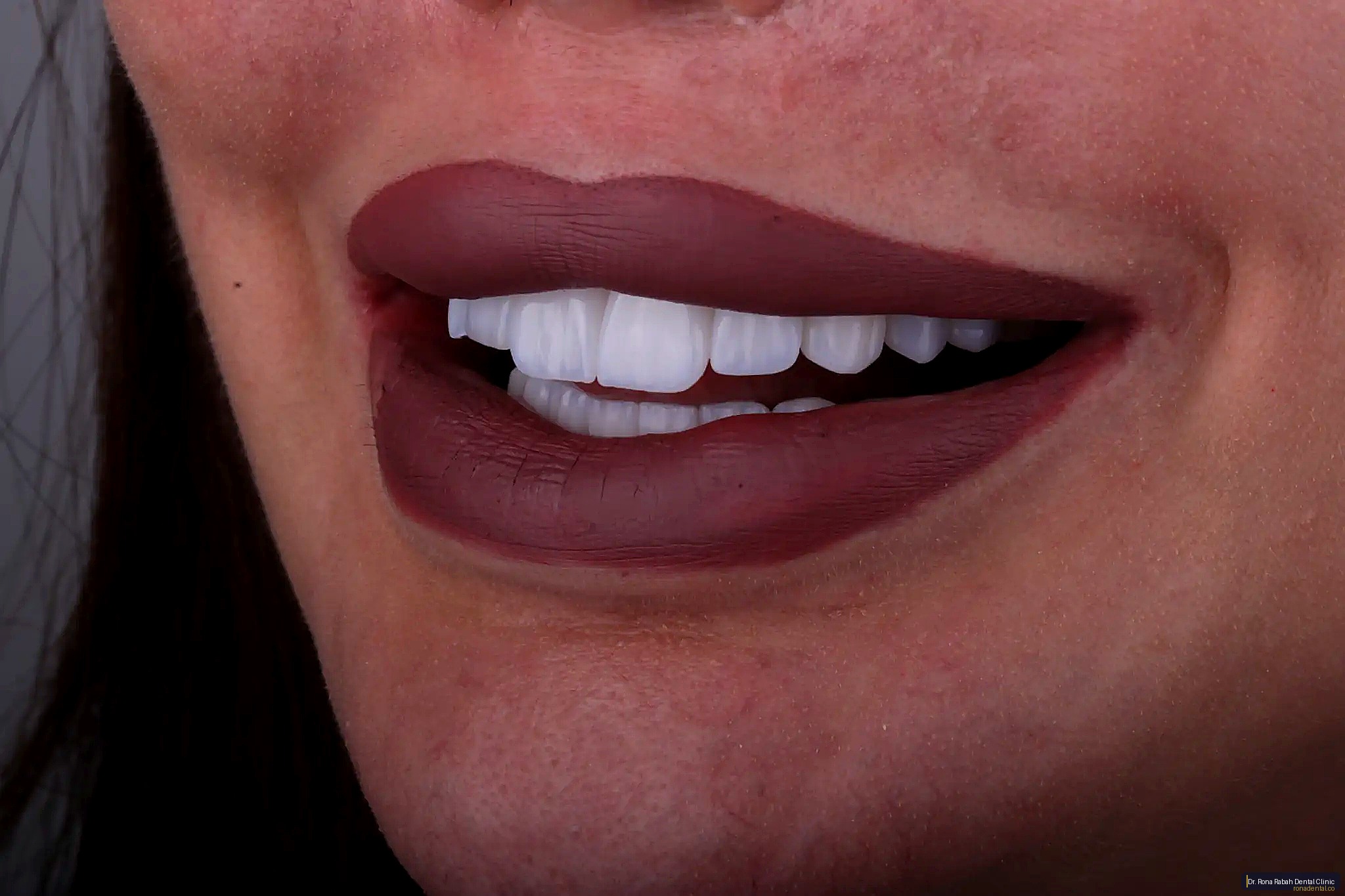 Zirconia Veneers · Bright Smile