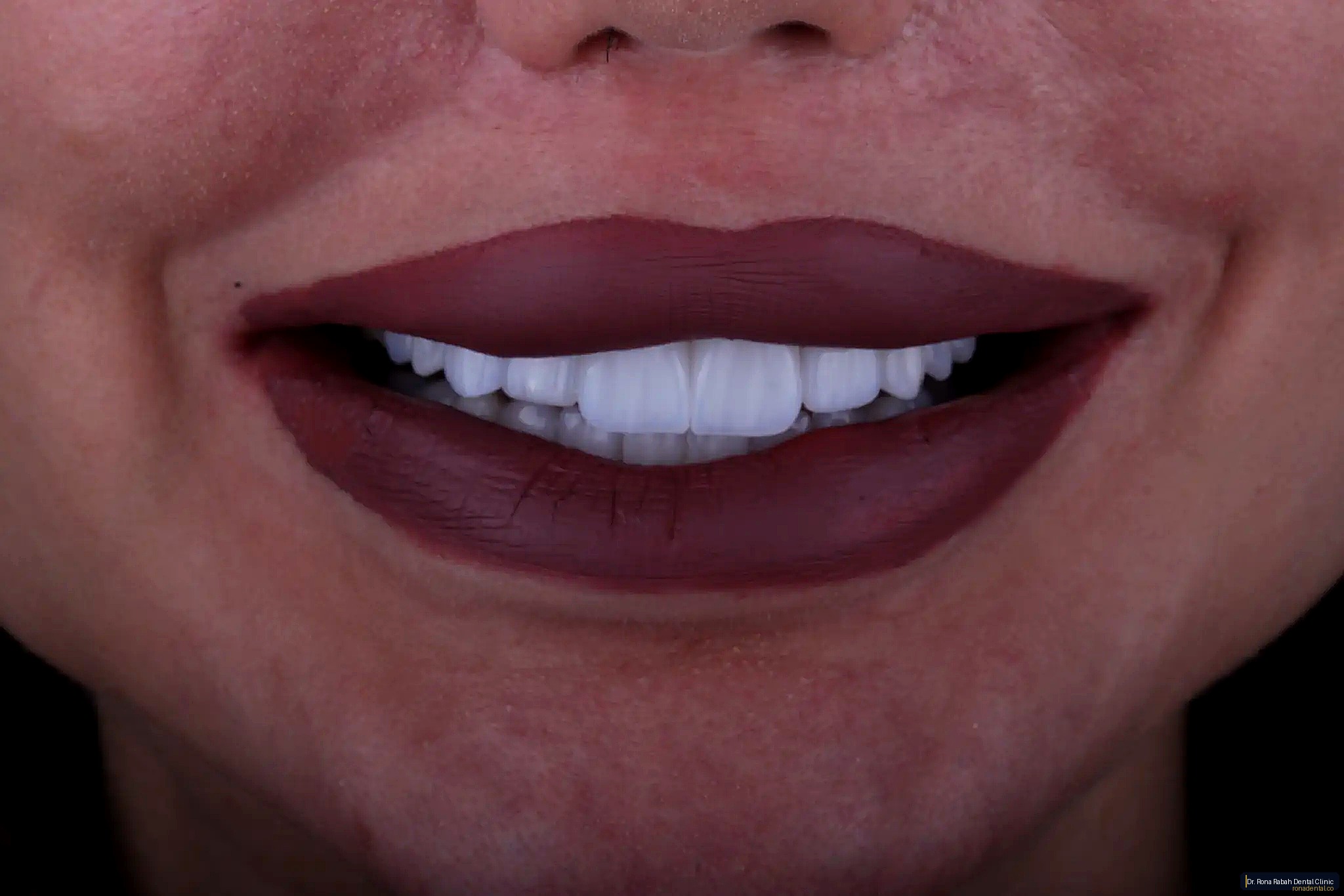 Cosmetic Dentistry · Veneers