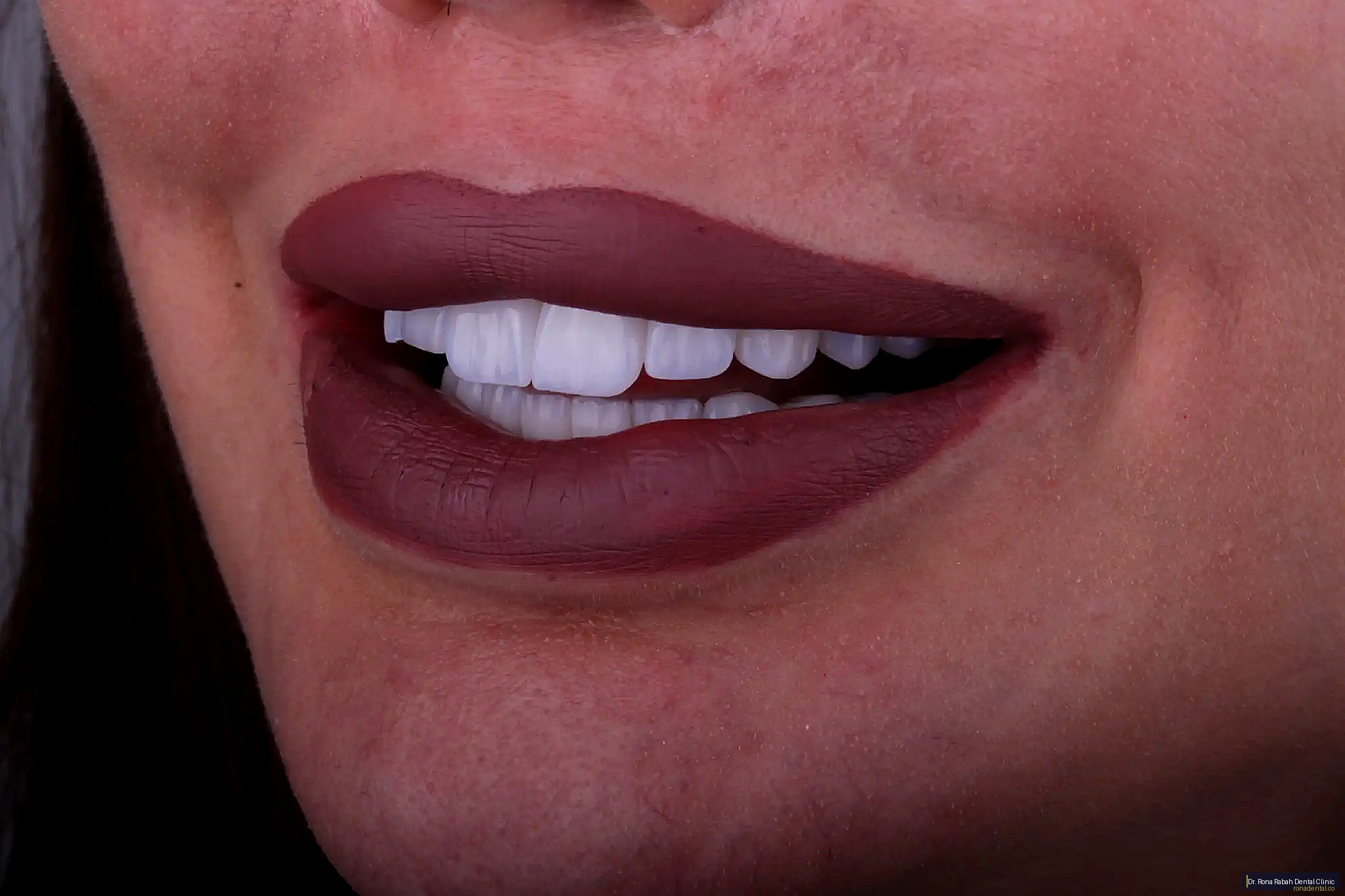 Smile Transformation · Veneers