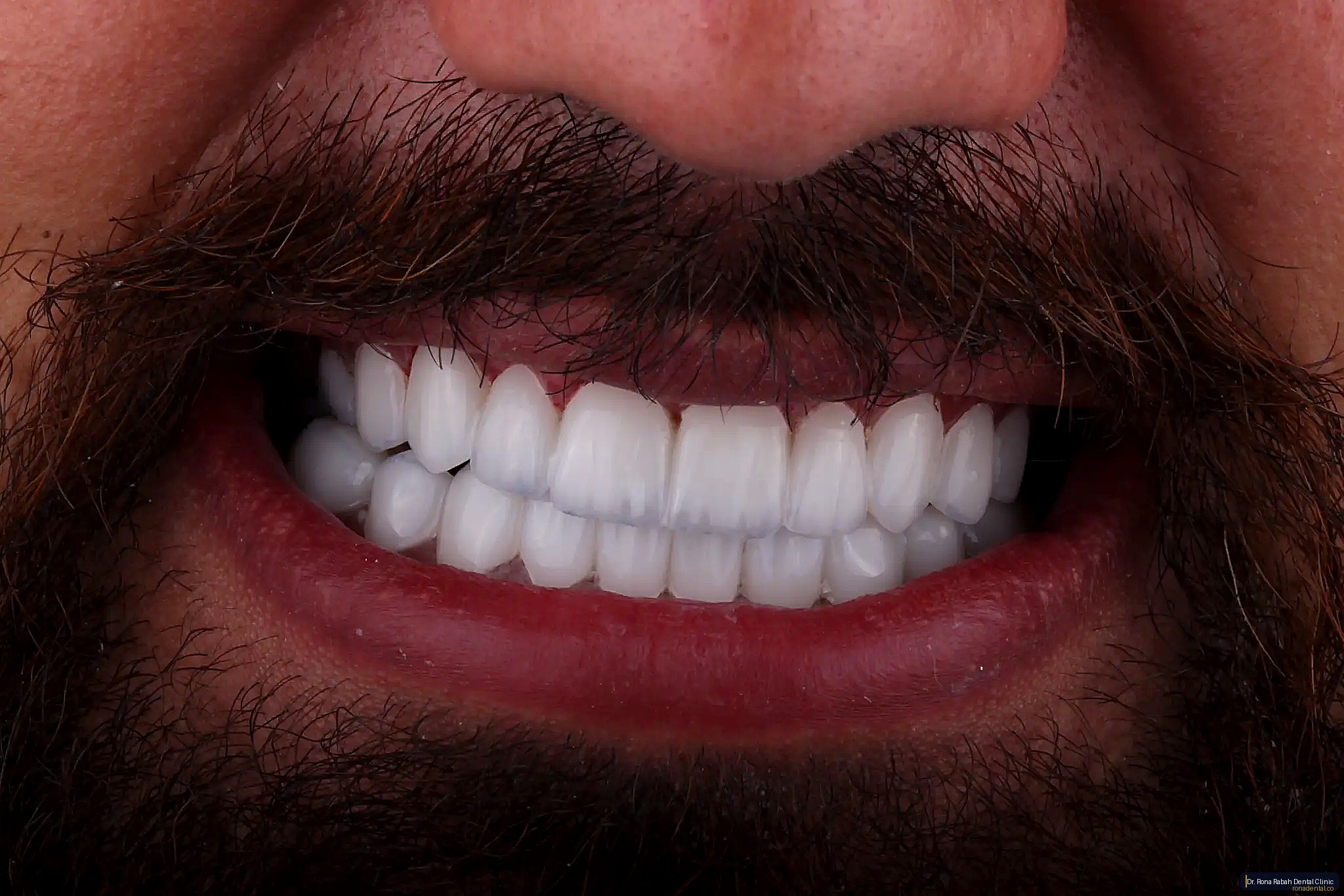 Hollywood Smile · Full Set