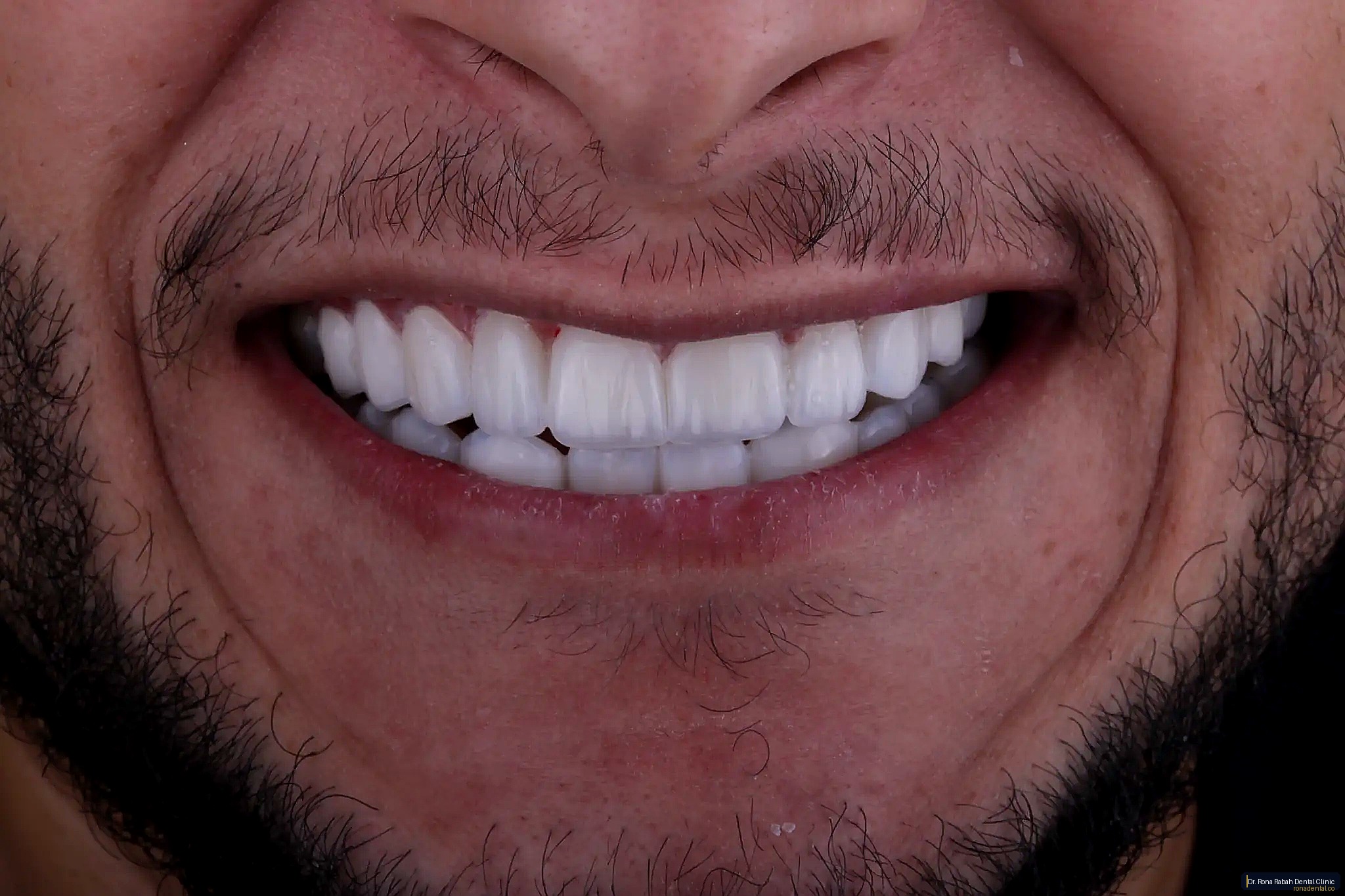 Smile Makeover · Veneers